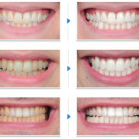 Điều trị răng sậm màu