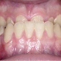 MỘT SỐ DẠNG ĐIỂN HÌNH CỦA VIỆC RĂNG MỌC KHÔNG THẨM MỸ Ở TRẺ MỚI LỚN VÀ LỰA CHỌN NẮN CHỈNH