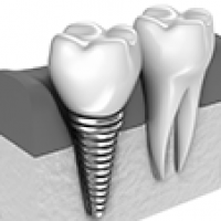 Implant