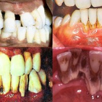 Nha chu - bệnh nguy hiểm trong nha khoa