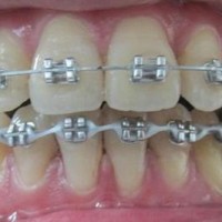 Niềng răng có tác dụng gì