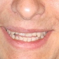 Những khiếm khuyết trong nụ cười