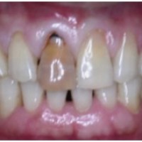 Nguyên nhân răng sậm màu